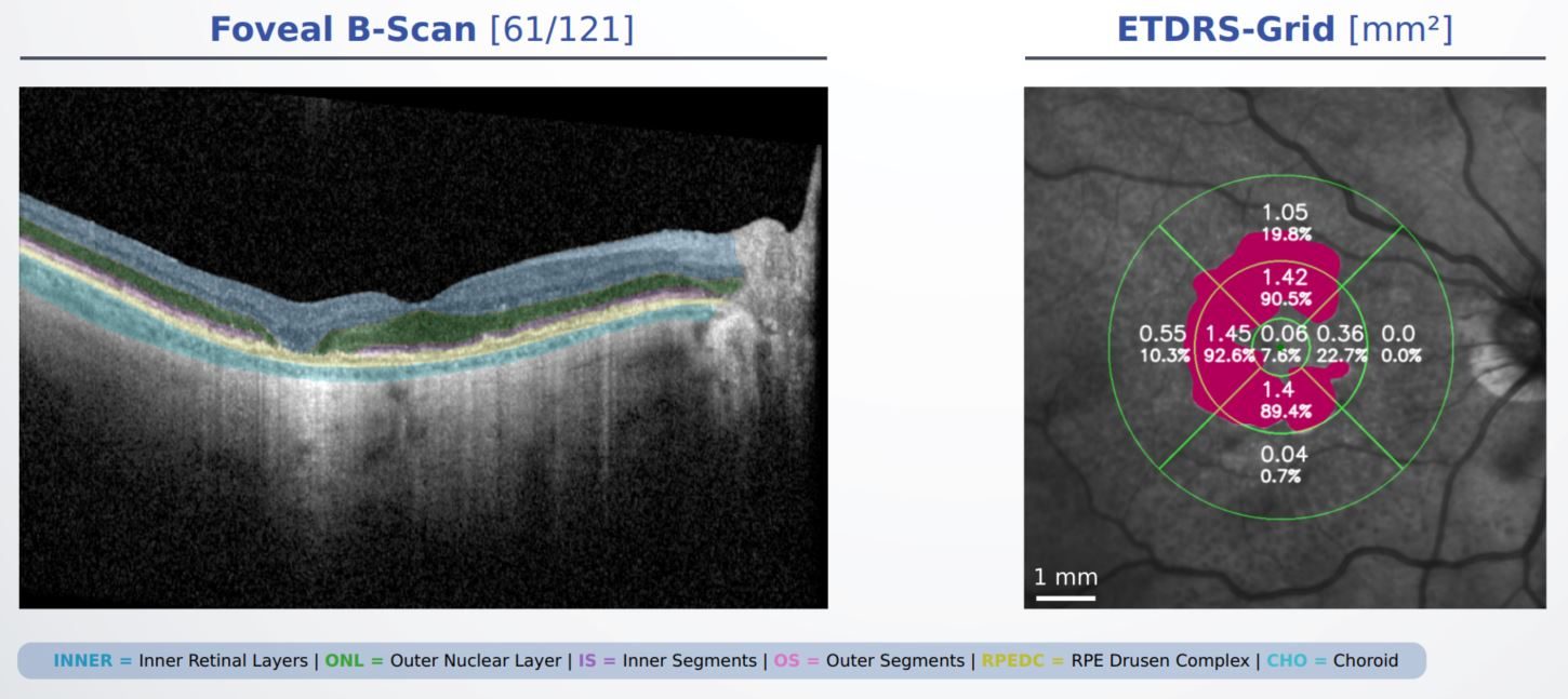 Report progression fovea2 Report progression fovea2